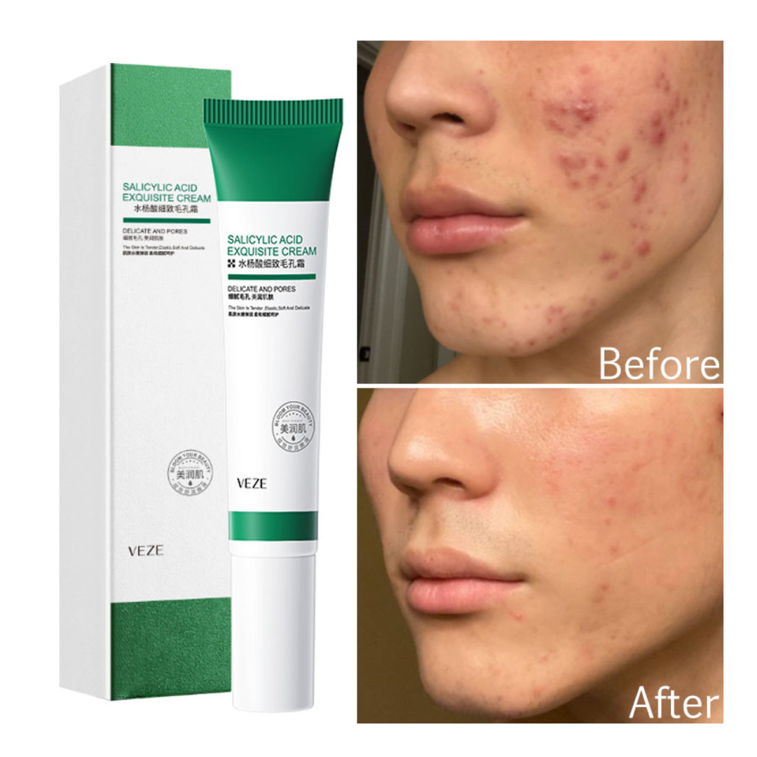 Crema cicatrizante antiacné con acido salicílico Venzen - Imagen 4